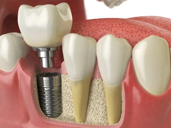 Dental Implant Butler