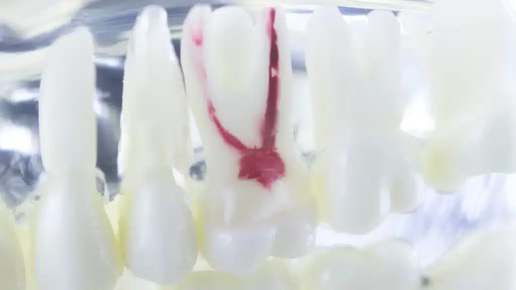 Signs that shows that the tooth needs root canal treatment