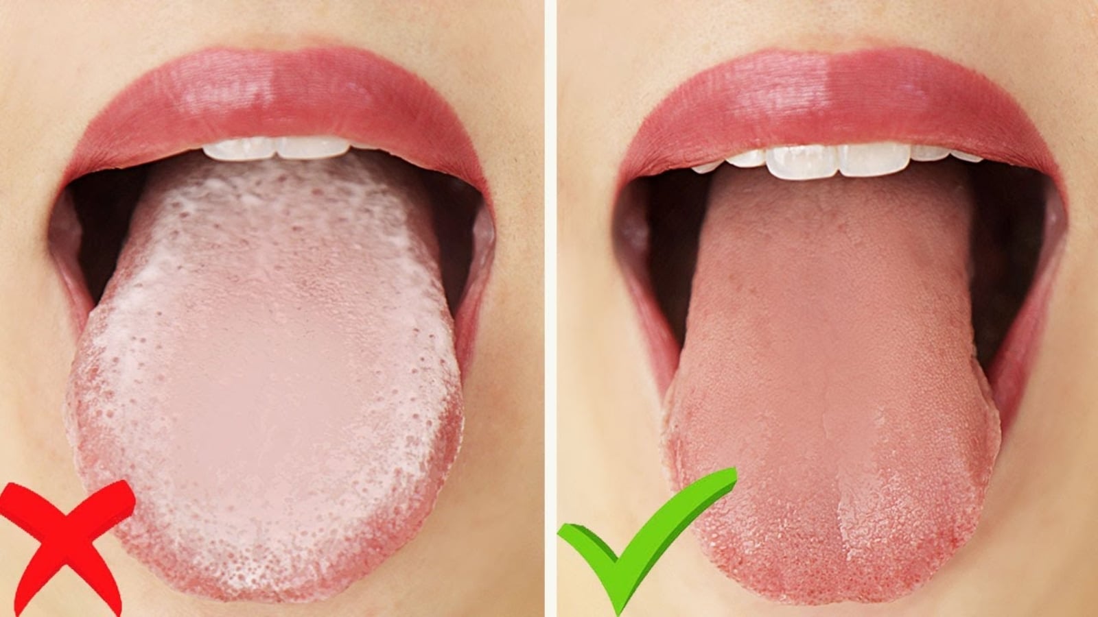 Does Your Tongue Need Cleaning? Here's Why It Matters