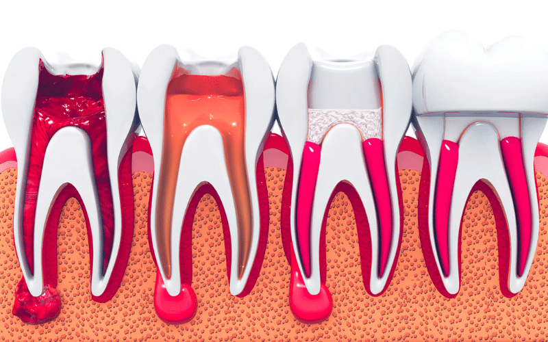 Reduce pain and swelling after root canal treatment