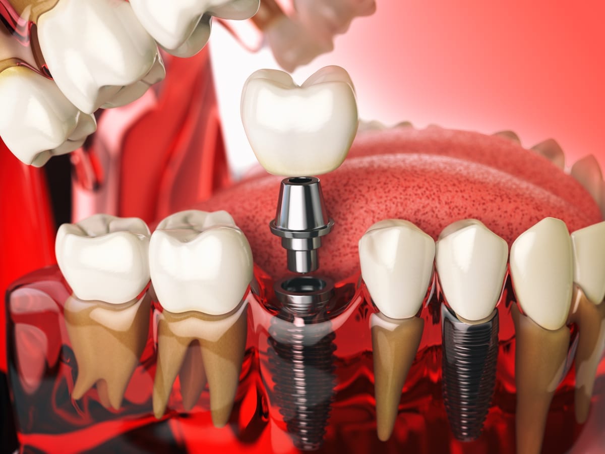 Dental Implants in Whitehall