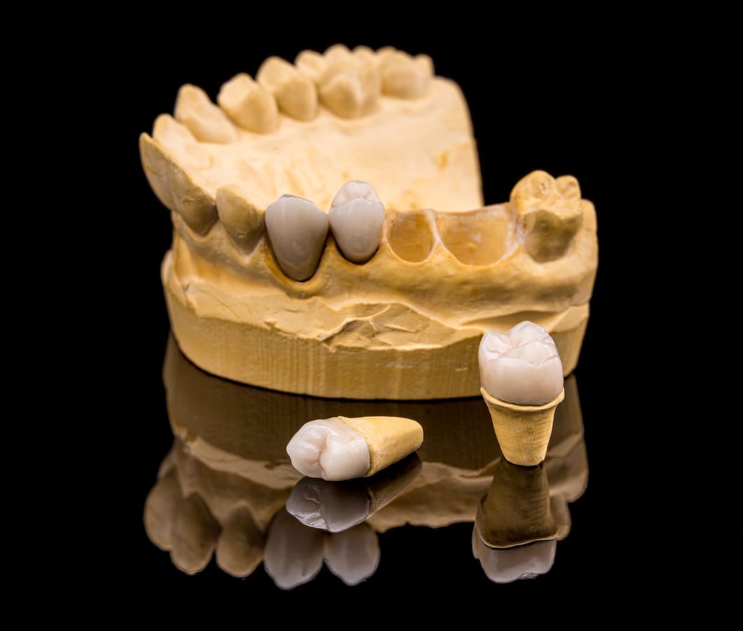Dental Crowns in Pittsburgh